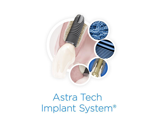 ASTRA TECH Implant System