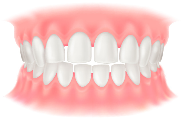 空隙歯列のイラスト