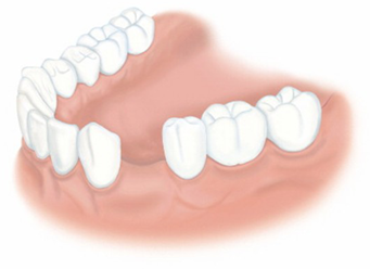 歯を1本失った場合 治療前