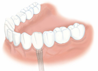 歯を1本失った場合 治療後