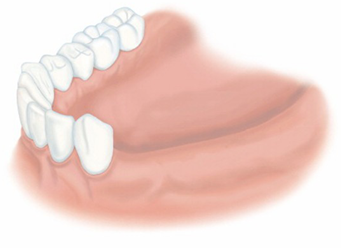 歯を何本か失った場合 治療前