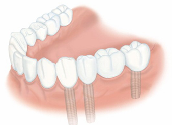 歯を何本か失った場合 治療後