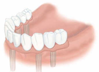 歯を全て失った場合 治療後