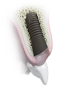 インプラント02