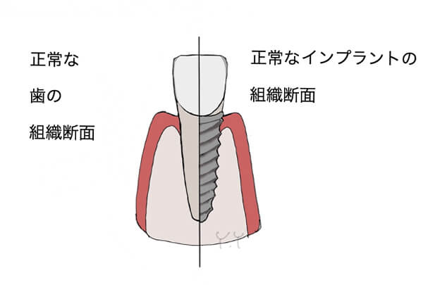 インプラント周囲炎01