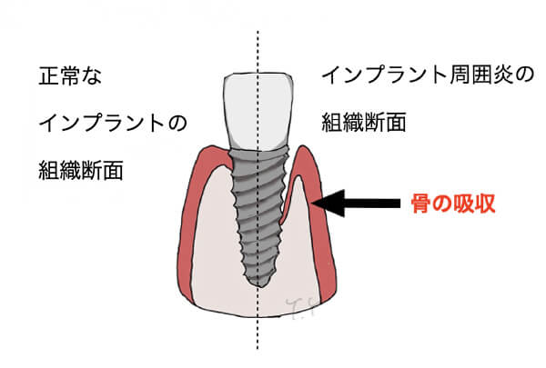 インプラント周囲炎02