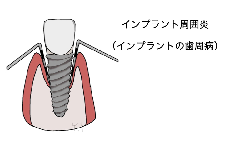 インプラント周囲炎03