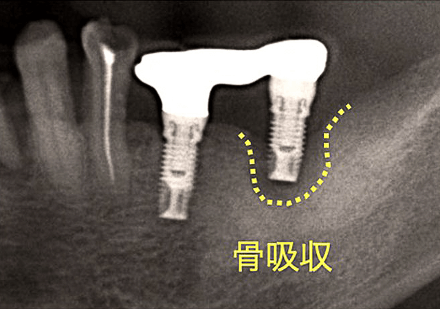 インプラント周囲炎レントゲンと写真01
