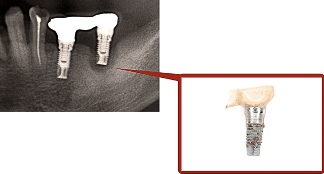 インプラント周囲炎レントゲンと写真02