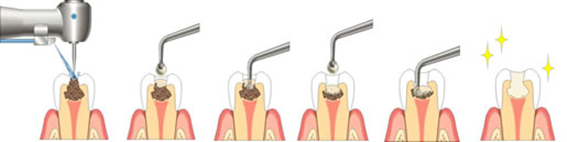削らないむし歯治療（カリソルブ）のイメージイラスト