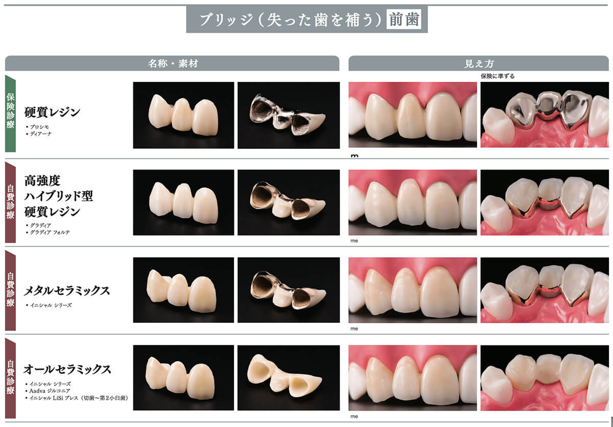当院で取り扱う詰め物・被せ物の特徴08
