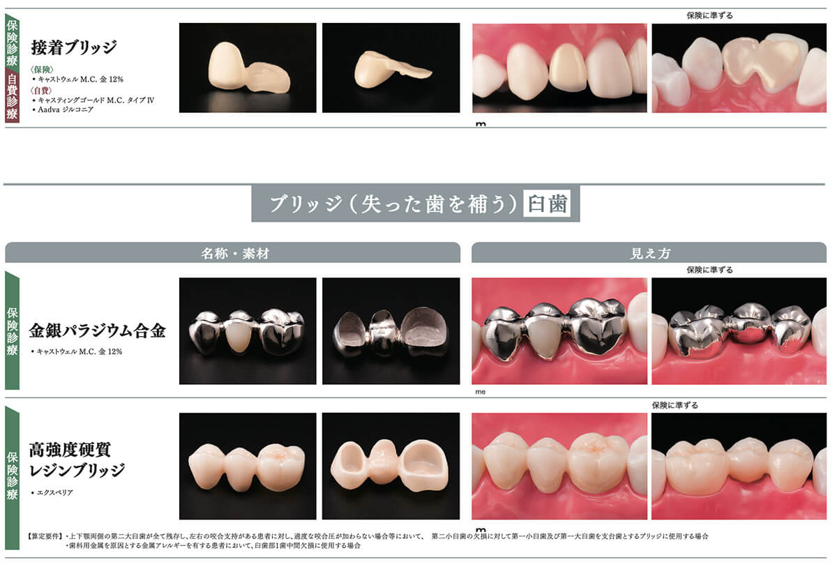 当院で取り扱う詰め物・被せ物の特徴09