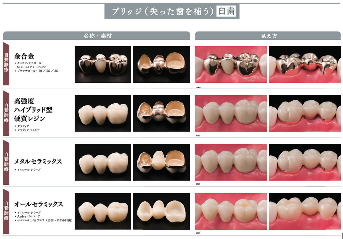 当院で取り扱う詰め物・被せ物の特徴10