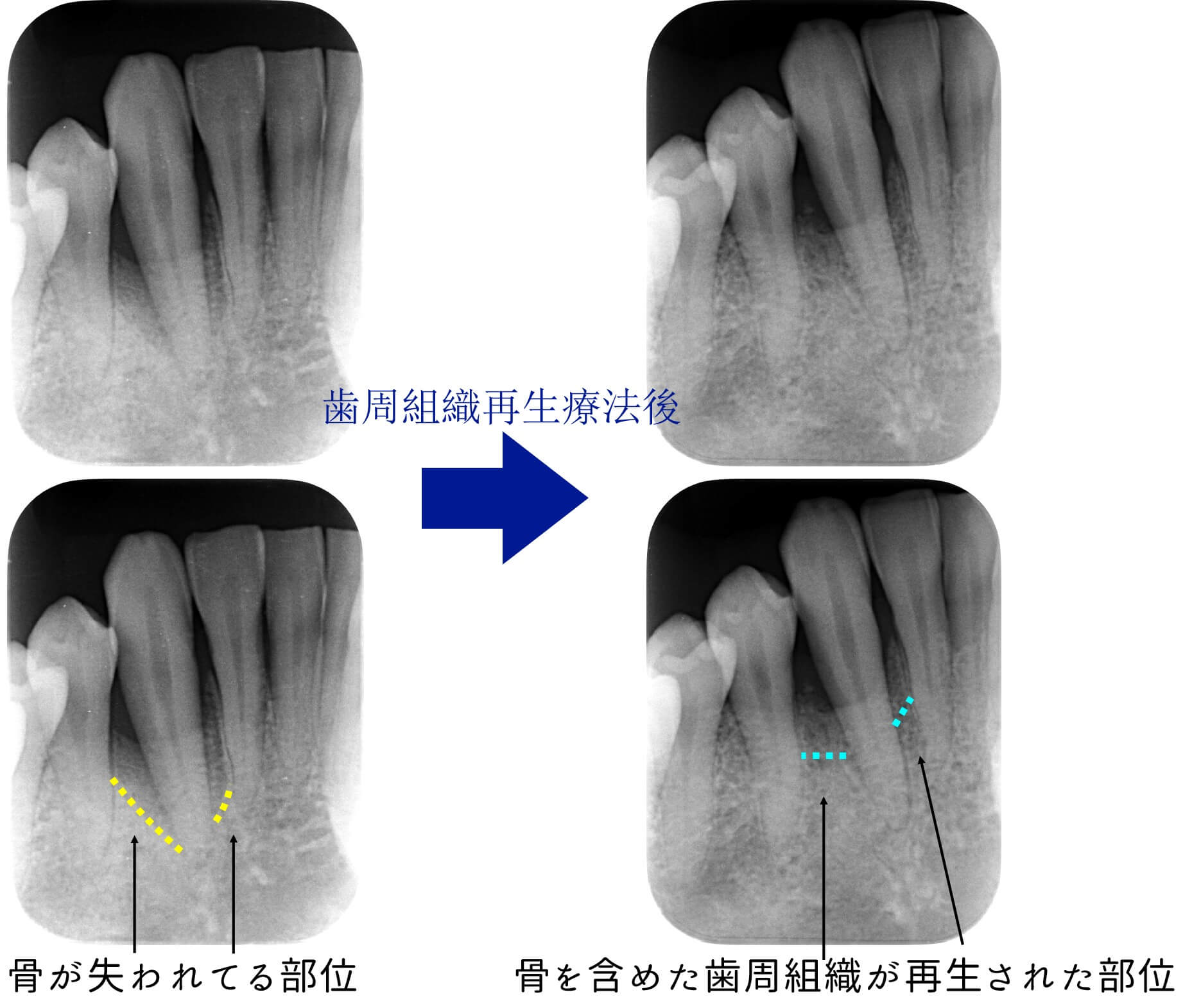 リグロスによる歯周組織再生療法