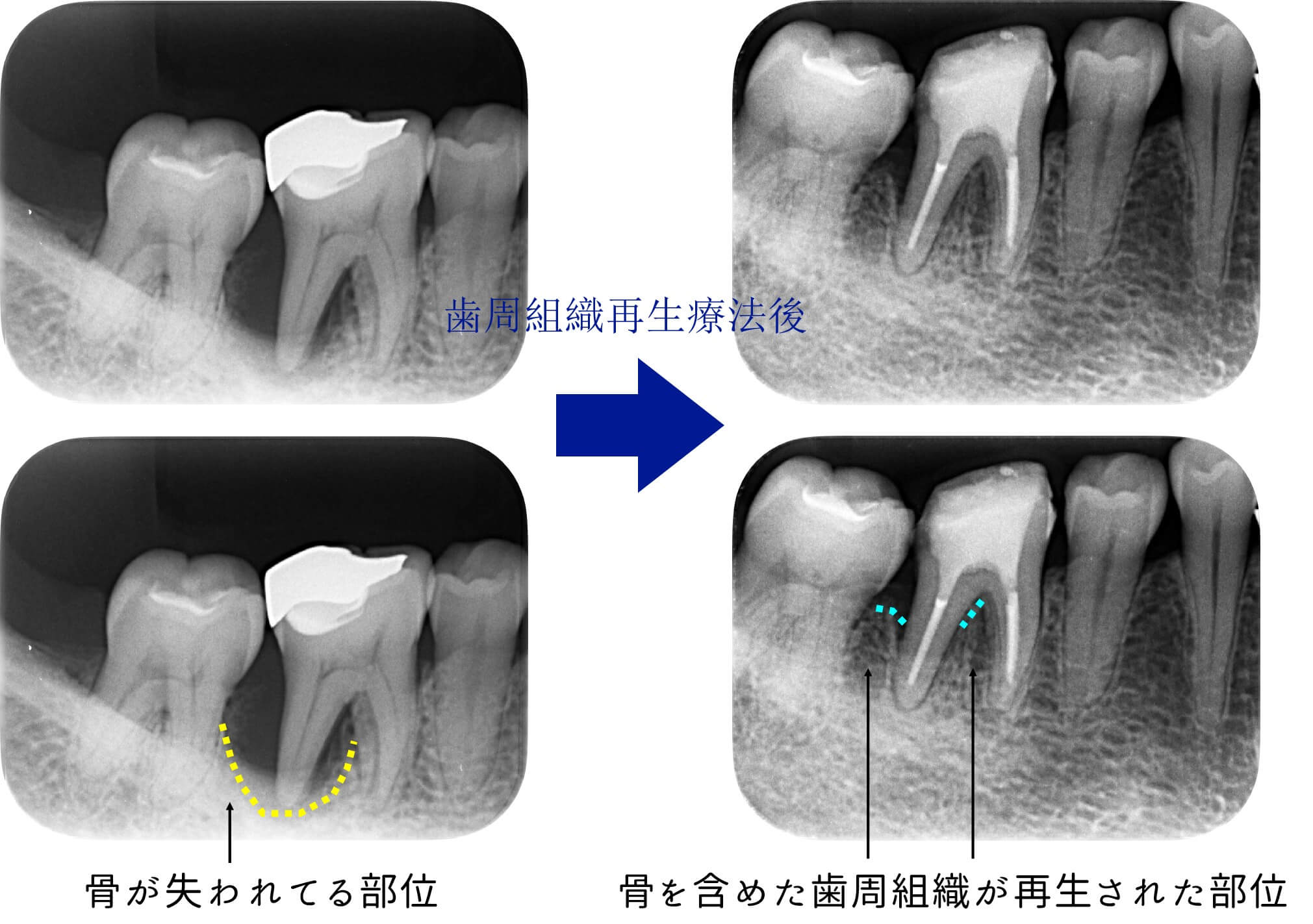 リグロスによる歯周組織再生療法