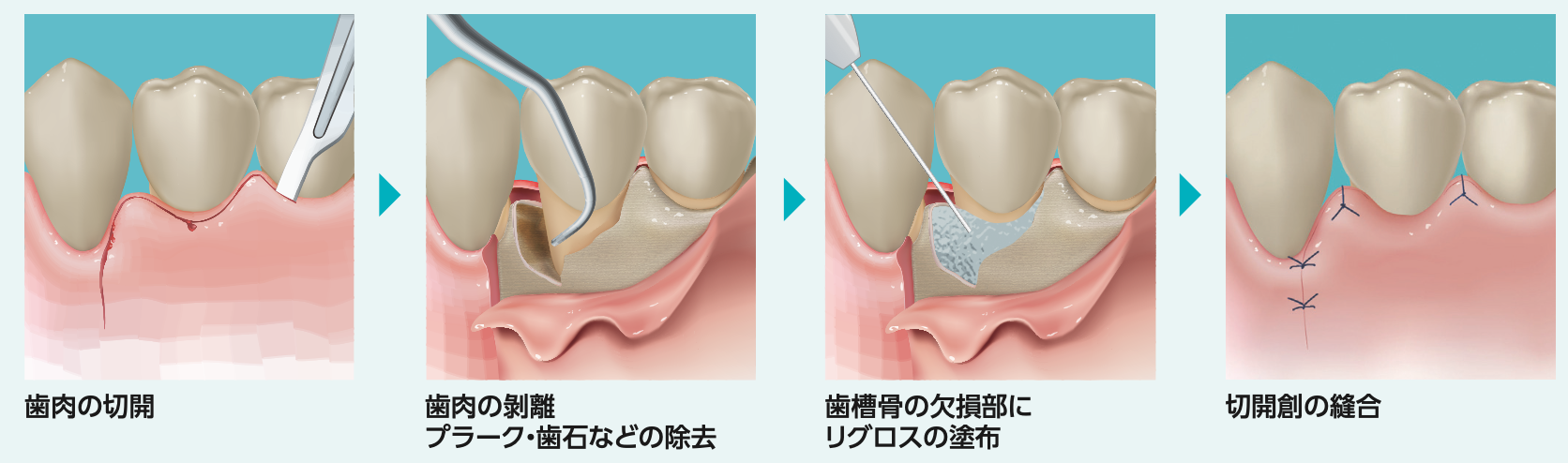 リグロスによる歯周組織再生療法01