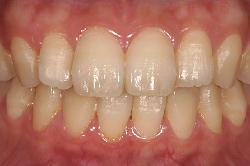 コーヒー・お茶・タバコ等に<br>含まれる色素