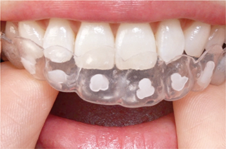 マウスピース装着