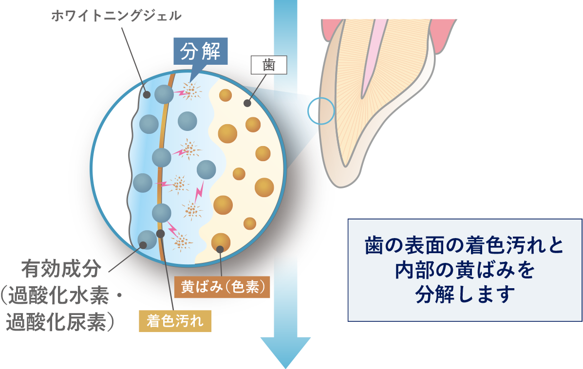医療ホワイトニングのメカニズム02