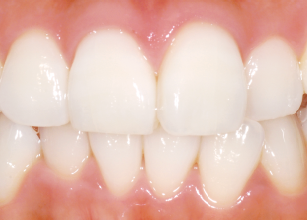 白い線模様(ホワイトバンド)なし