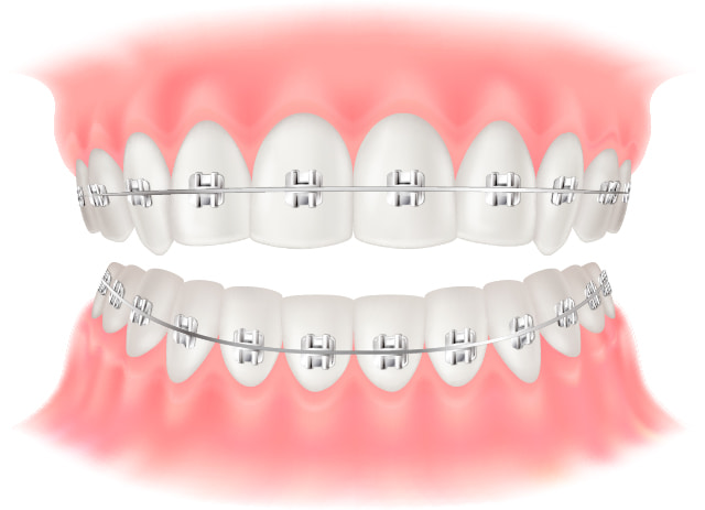 ワイヤー矯正のイラスト