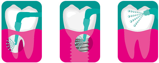 治療イメージ図